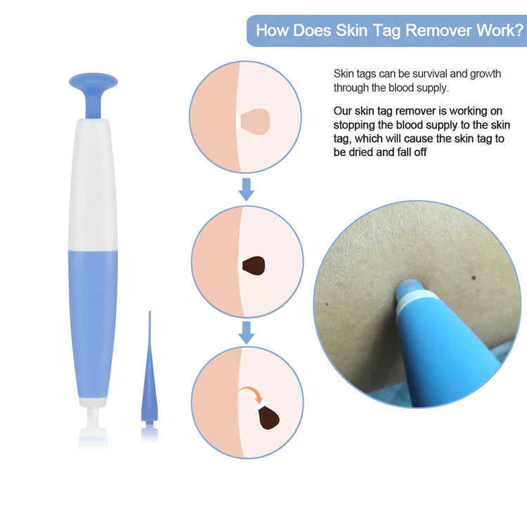 Skin Tag Removal Kit – At-Home Skin Tag Treatment