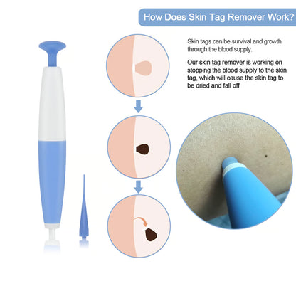 Skin Tag Removal Kit – At-Home Skin Tag Treatment
