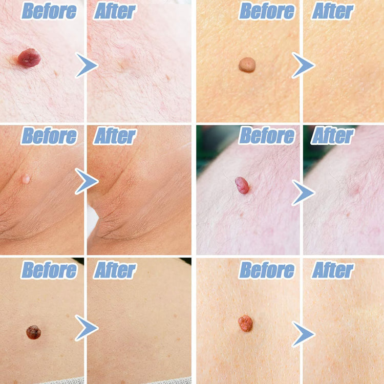 Skin Tag Removal Kit – At-Home Skin Tag Treatment