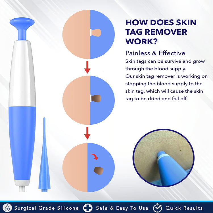 Skin Tag Removal Kit – At-Home Skin Tag Treatment