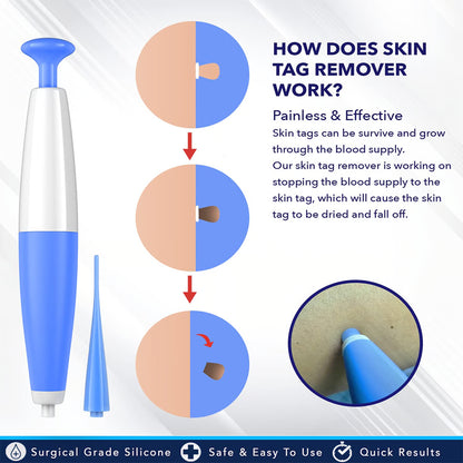 Skin Tag Removal Kit – At-Home Skin Tag Treatment