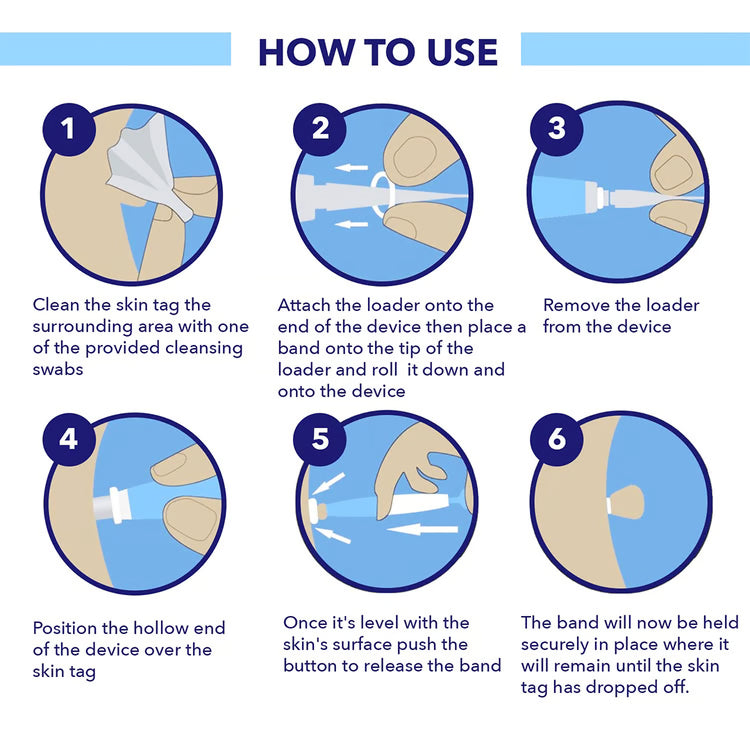 Skin Tag Removal Kit – At-Home Skin Tag Treatment