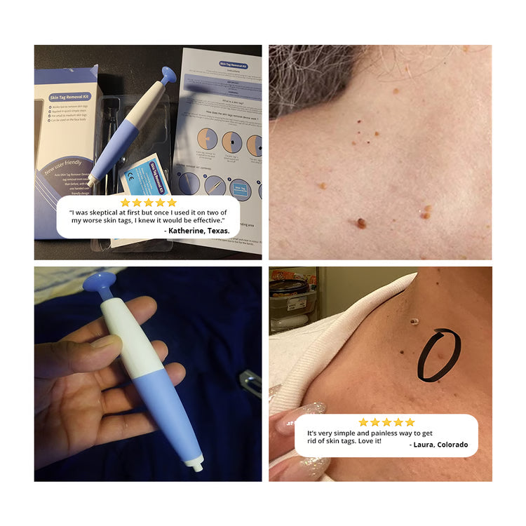 Skin Tag Removal Kit – At-Home Skin Tag Treatment